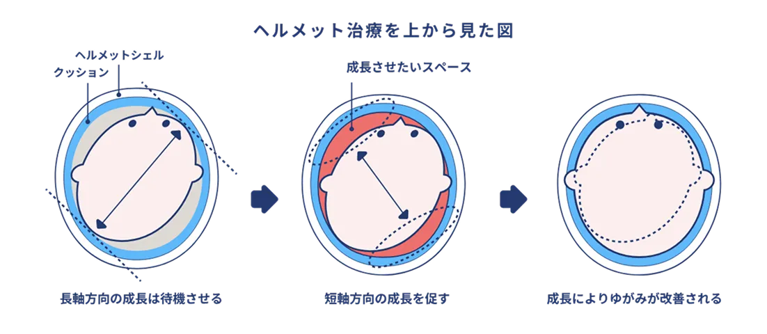 ヘルメット治療の仕組み